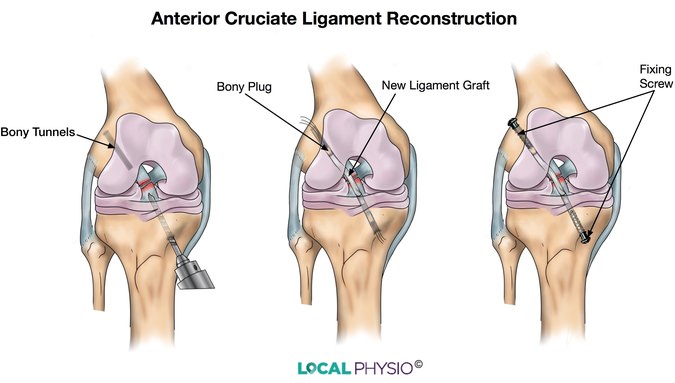 Anterior Cruciate Ligament (ACL) Injury