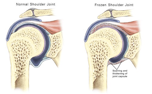 Frozen Shoulder Anatomy