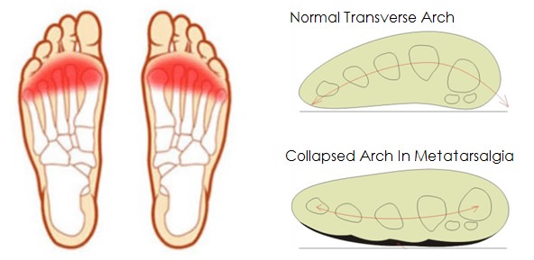 Metatarsalgia Collapsed Arch Illustration