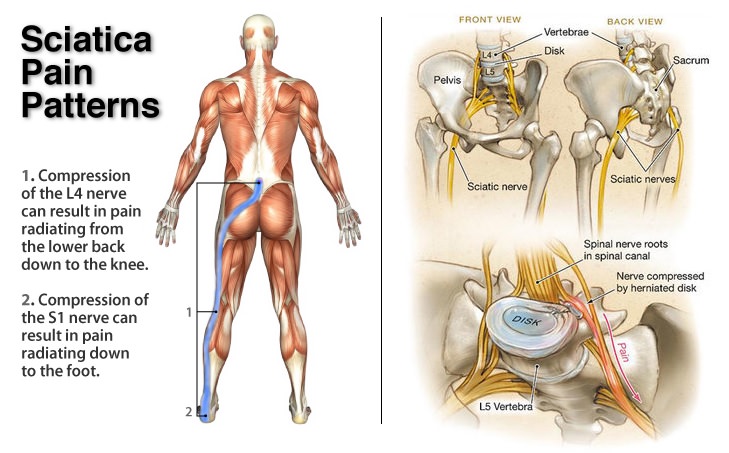 Sciatica  How Physiotherapy Management helps in Relieving the