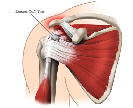 Rotator Cuff Tear Illustration