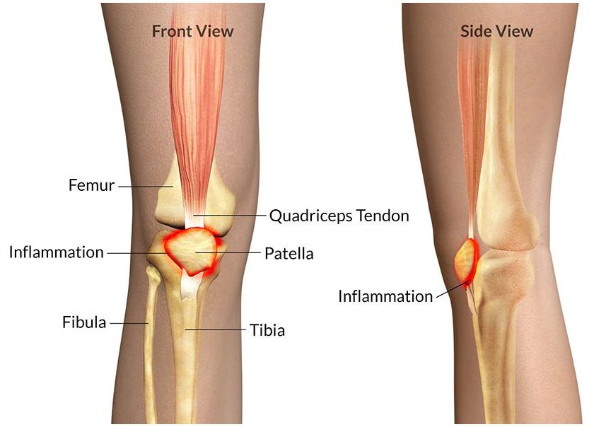 Patellofemoral Pain Syndrome