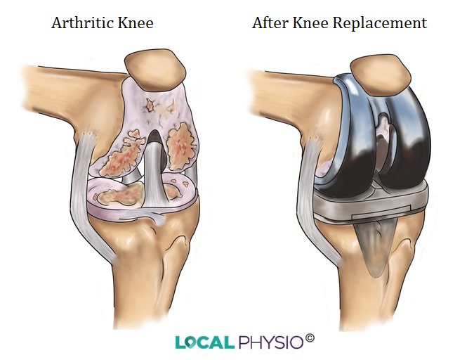 Knee Replacement