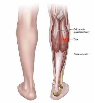 Anatomy of a Calf Strain