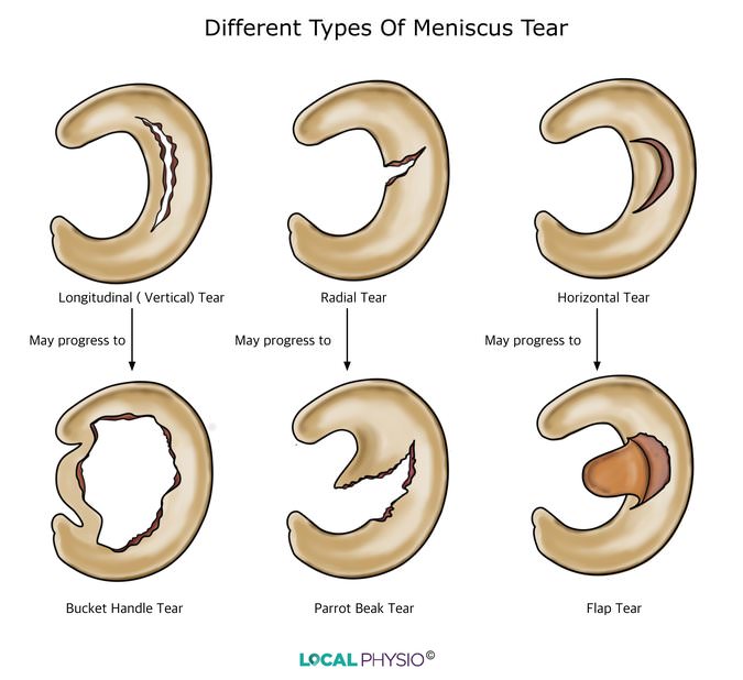 Meniscus Tear Types
