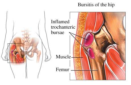 Hip Bursitis