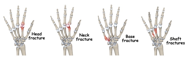 Metacarpal Fracture Illustration