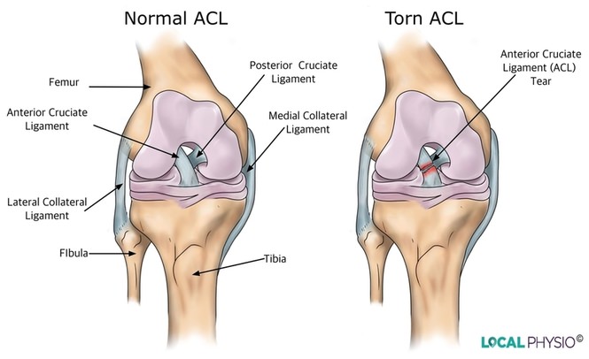 ACL Tear Illustration