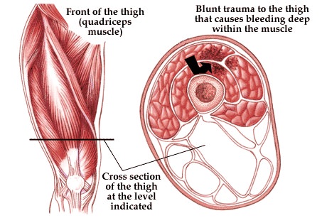 Front Thigh Contusion