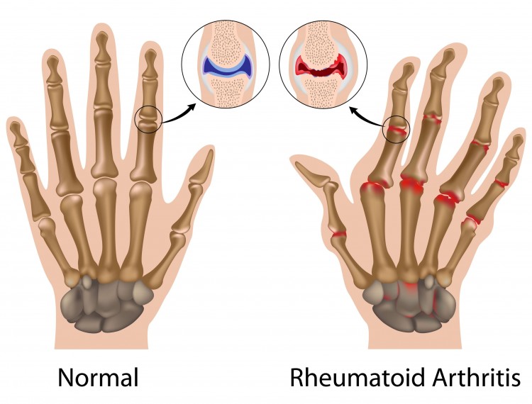Arthritic Hands