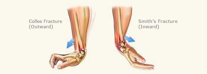 Wrist Fracture Anatomy