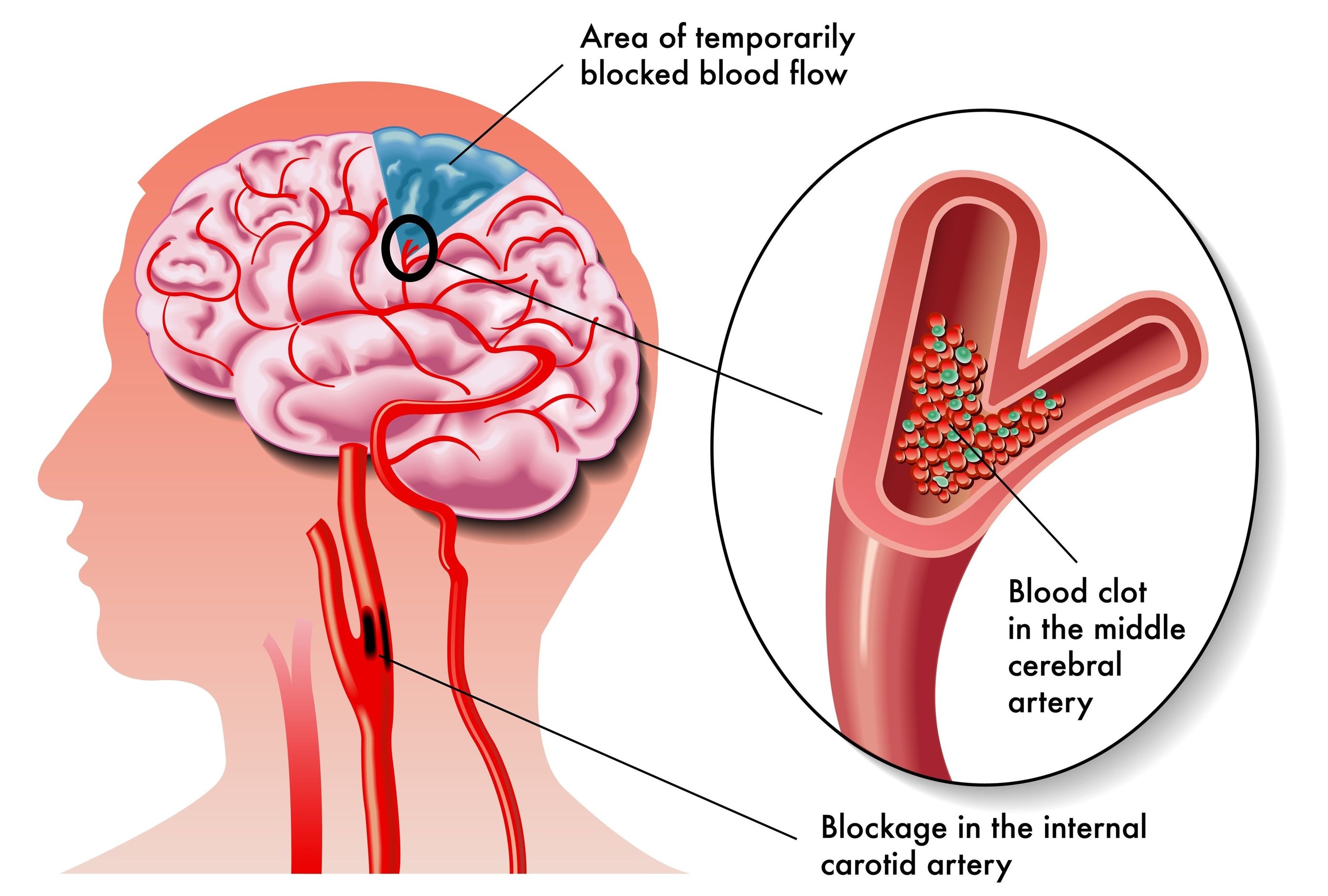 Ischemic Stroke