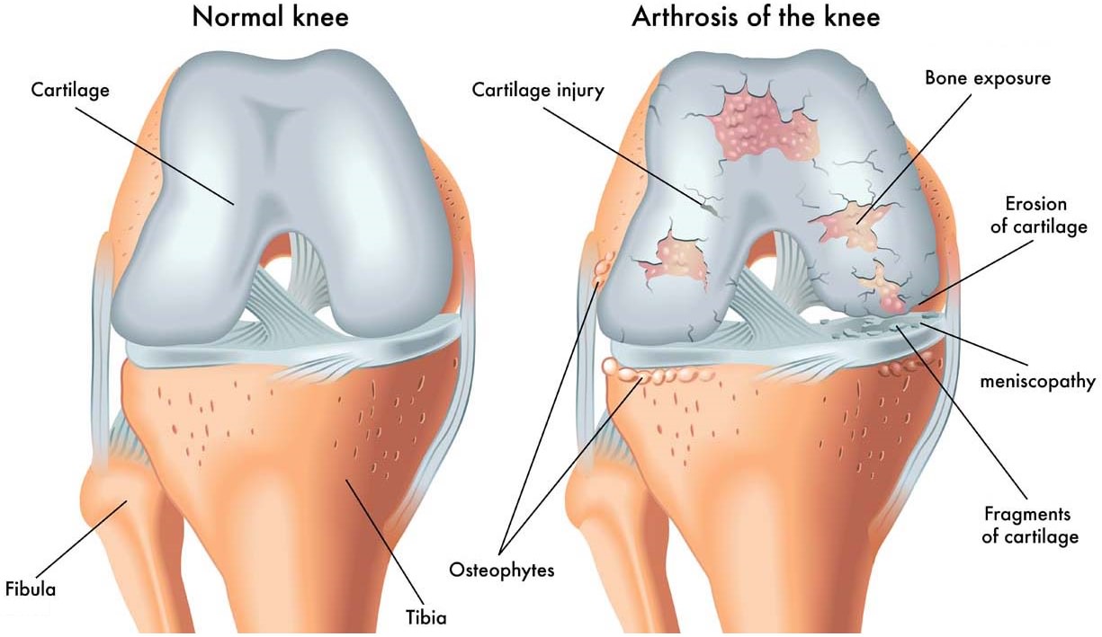 osteoarthritis és térd osteoarthritis