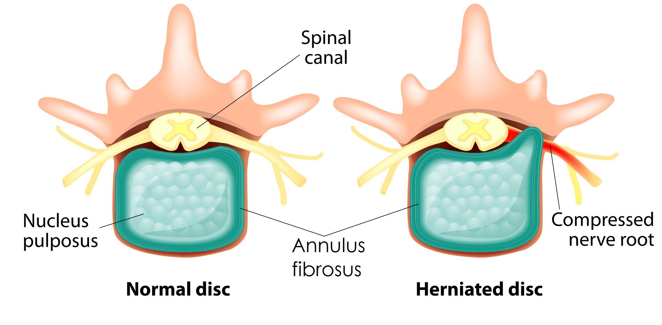 Slipped Disc