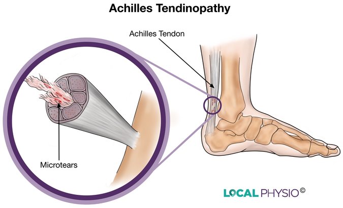 Achilles Tendon Illustration