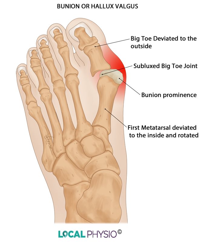 Bunion Illustration