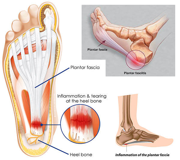 Plantar Fasciitis: A Painful Heel - Hughston Clinic