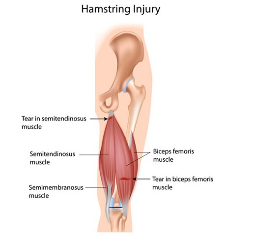 Hamstring Injury Anatomy