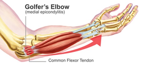 Golfer?s Elbow Anatomy