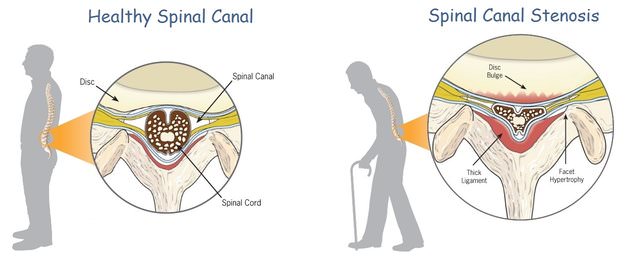 Spinal Stenosis Illustration