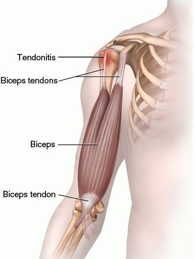 Bicipital Tendonitis Anatomy
