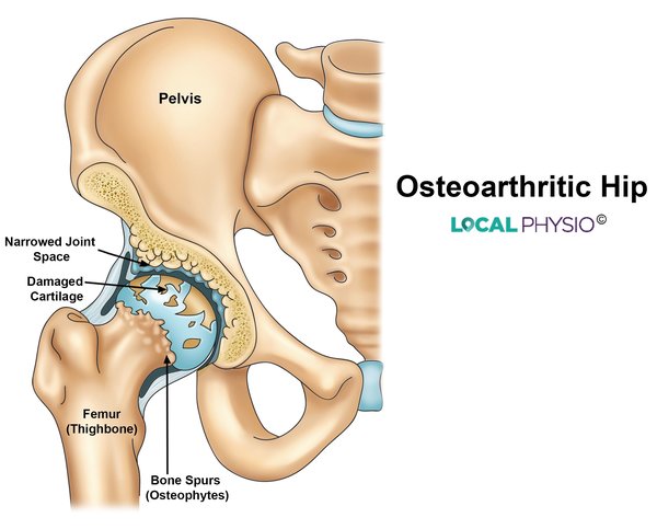 Arthritic Hip