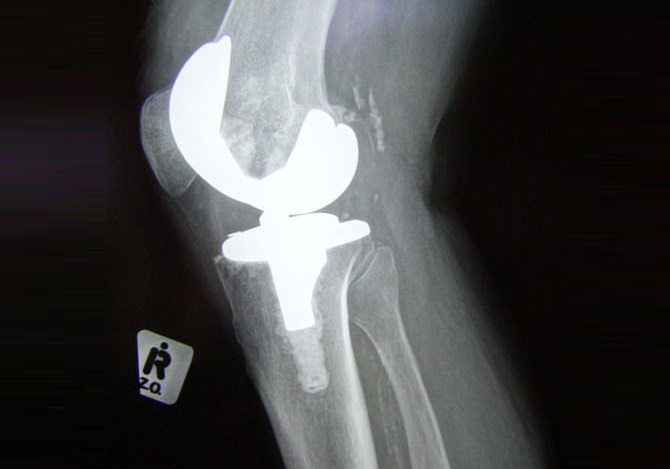 Knee Replacement Xray