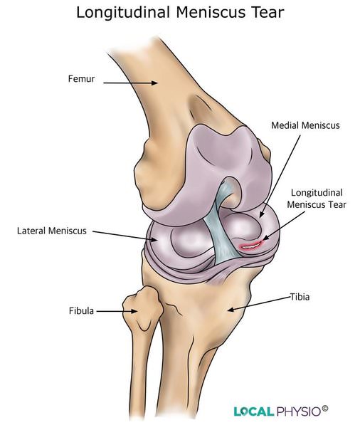 medial meniscus tear