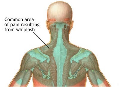 Common Whiplash Pain Illustration