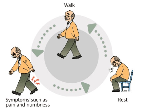 Spinal Stenosis Symptoms