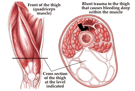Muscle Rupture Thigh Thigh Contusion | Local Physio