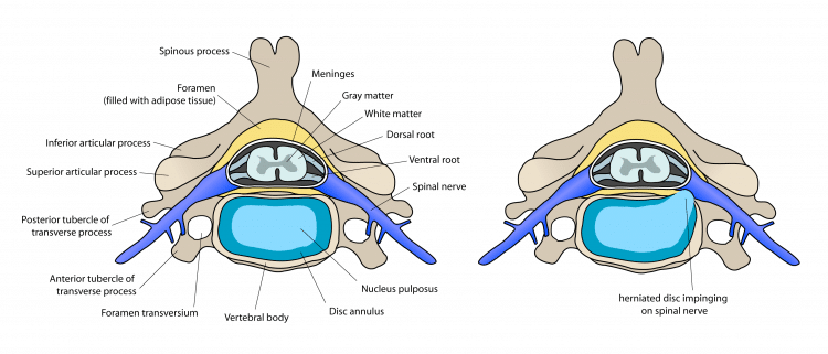 Prolapsed Disc