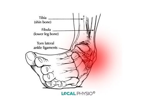 Ankle - Causes & Treatments | Local Physio
